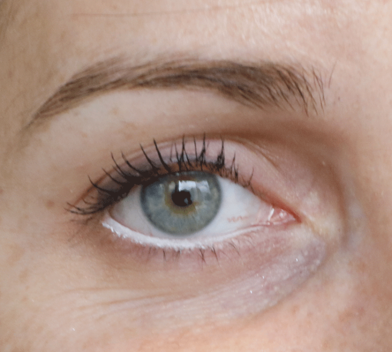 Petit Bouton Blanc Au Ras Des Cils Inférieur