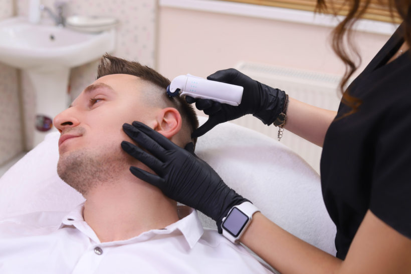 microneedling