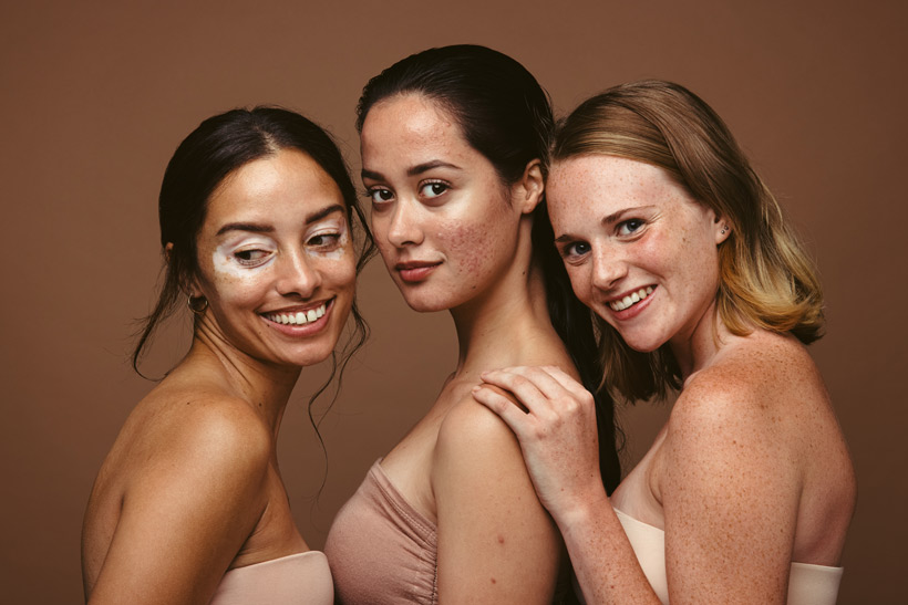Skin Positivity : Le mouvement qui bouleverse le mythe de la peau parfaite